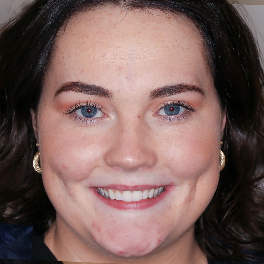 Composite Bonding - smile 22 - after - 3Dental